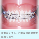 左側がメタル、右側が透明な装置になります。